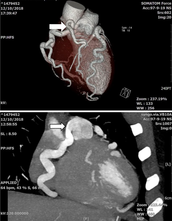 Coronary CT angiogram, dilated aneurysmal RCA originating from pulmonary artery (white arrow).