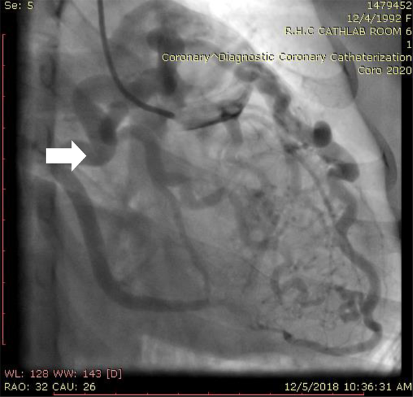 Selective coronary angiography left main injection revealed aneurysmal LAD, normal LCX, RCA was filled retrograde from left system and drained to pulmonary artery (white arrow).