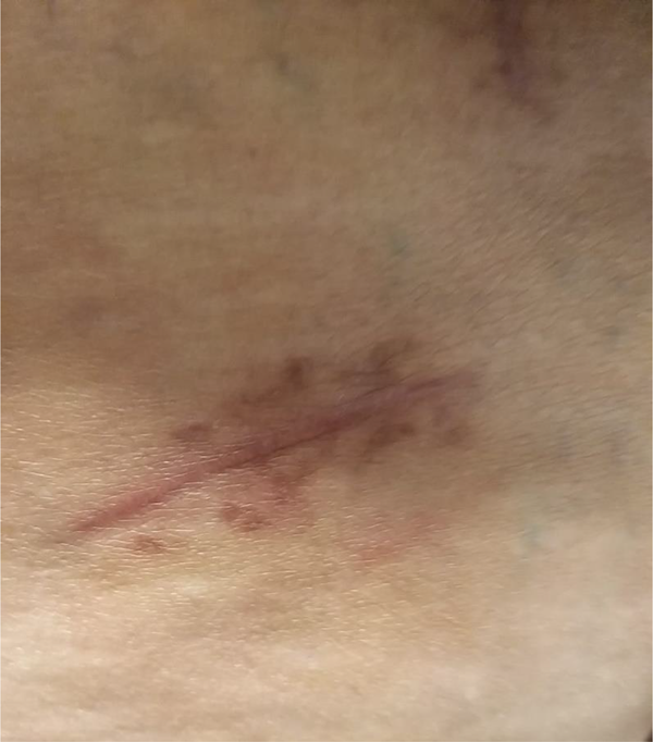 IPG pocket after treatment
