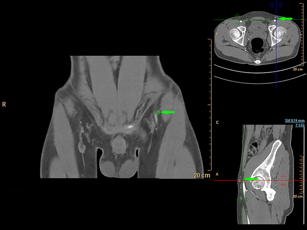 Computed tomography angiography (CTA) multiple views for visualization of the superficial circumflex iliac artery (arrows)