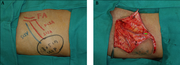 Intraoperative identifications of the perforators (A) and superficial circumflex iliac artery (arrow) (B)
