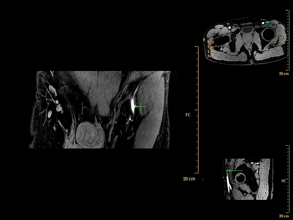 Multiple three dimensional time-of flight magnetic resonance angiography (3D TOF-MRA) displaying the views of the superficial circumflex iliac artery (arrows)