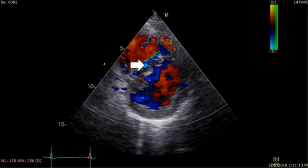Parasternal short axis view with turbulent abnormal flow in the interventricular septum (white arrow).