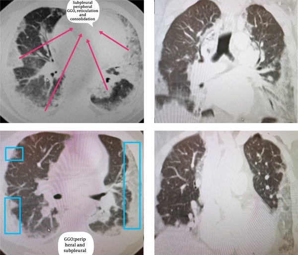 An axial CT image obtained without intravenous contrast in a 49-year-old male in the “late” time 23 December 2019 (10 days from symptom onset to this CT) shows bilateral reticulations and patchy consolidations opacities, with a striking subpleural peripheral distribution, subpleural lower lobe predominant Ground glass opacities.