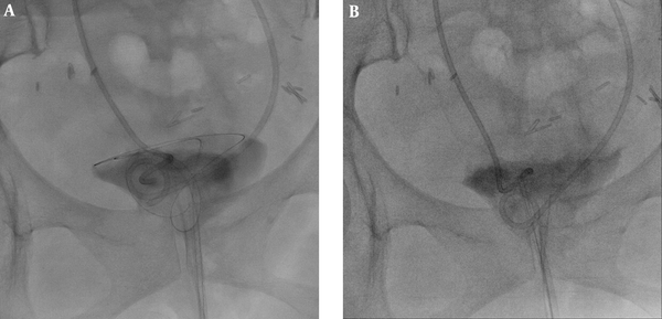A 53-year-old woman had two DJ stents due to ovarian cancer with bladder metastasis. The patient was referred to our department to replace the DJ stents, which were functioning poorly. A, After the conventional technique using a snare catheter failed, an 8-Fr introducer sheath was inserted through the urethra into the bladder. Then, a bent, 0.018-inch guide-wire was inserted through the sheath. Multiple loops were made by pushing the long string; B, When the DJ stent entered one of the loops, the short and long strings were pulled out simultaneously to introduce both strings into the sheath.