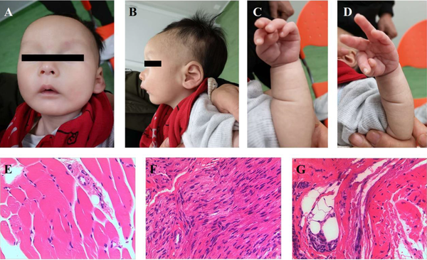 Photos of current case. (A) Narrow bifrontal diameter, widely-spaced and almond-shaped eyes (often in mild upslanted position), blue sclera, full cheeks, small mouth, thin upper lip, downturned corners of the mouth, micrognathia; (B) High prominent forehead, low-set ear; (C-D) A peculiar position of the hands, with the thumb constantly adducted over the index and middle finger. Pathological images of muscle biopsy. (E) Small striated muscle tissue; (F) Large nerve fibers; (G) A small amount of compressed muscle fiber, dilated small blood vessels.