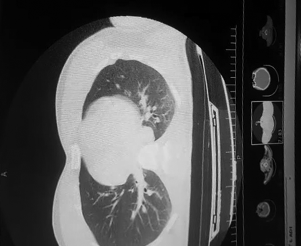 Chest CT scan with ground glass opacities suggestive of the coronavirus
