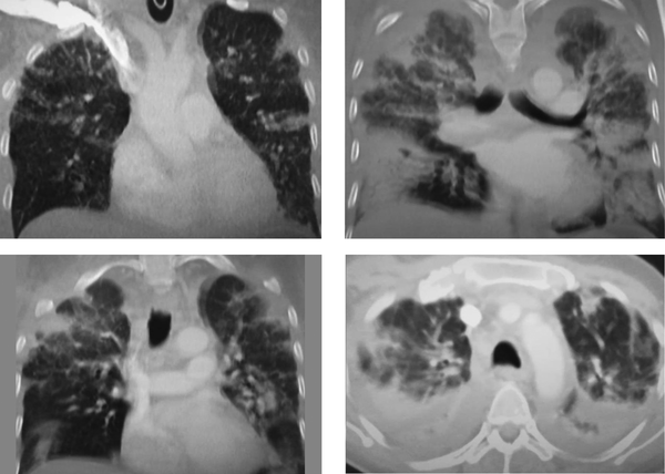 An axial CT image obtained without intravenous contrast in a 51-year-old male in the “late” time 19 December 2019 (8 days from symptom onset to this CT) shows severe Ground-glass opacification and consolidation in right and left lower and upper lobe.
