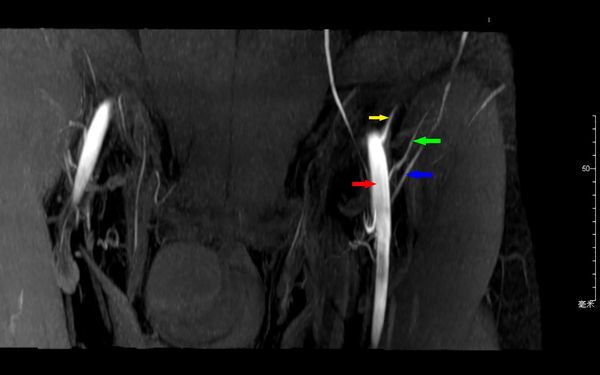 Maximum intensity projection view of the left groin region. Green arrow, superficial circumflex iliac artery; blue arrow, superficial circumflex iliac vein; red arrow, femoral artery; yellow arrow, deep circumflex iliac artery.