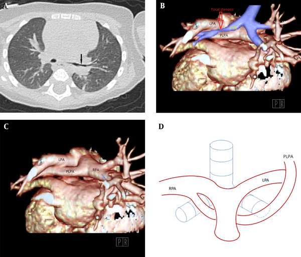 A, Chest CT in the lung window setting. B-C, 3D volume-rendered images showing focal stenosis of the left main bronchus (arrow) posterior to the partial anomalous left pulmonary artery (PLPA). D, The PLPA courses upward to supply the left upper lobe, labeled PLPA in the corresponding diagram in our case.