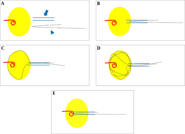 A, Prepare the introducer sheath (blue arrow) and a 0.018-inch guide-wire (blue arrowhead). Bend the end of the guide-wire as much as the sheath length. The yellow circle represents the lumen, such as a bladder or a renal pelvis; B, Insert the introducer sheath in the lumen and push the bent end of the guide-wire through the sheath; C, Create a loop by pushing the long string. The short string should be held to prevent the folded end from entering the lumen; D, When the long string is inserted continuously, the loop touches the lumen wall, and multiple loops are created due to the elasticity of the guide-wire; E, If a foreign body enters the loops, pull the short string and the long string simultaneously and guide both strings into the sheath. Finally, remove the foreign body along with the sheath.