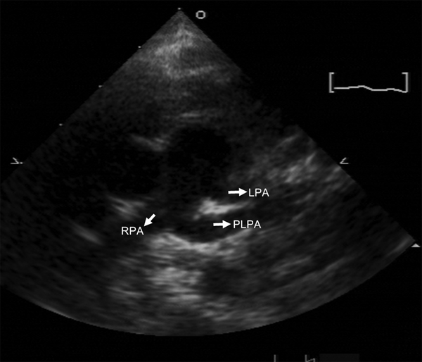 Echocardiogram showing partial anomalous left pulmonary artery (LPA) (PLPA) arising from the right pulmonary artery (RPA).