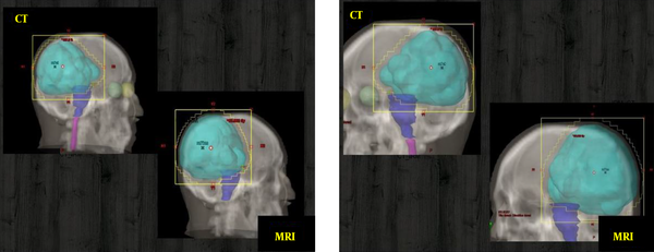 3D images showing the difference between Glioma’s PTV delineated on CT and MRI images