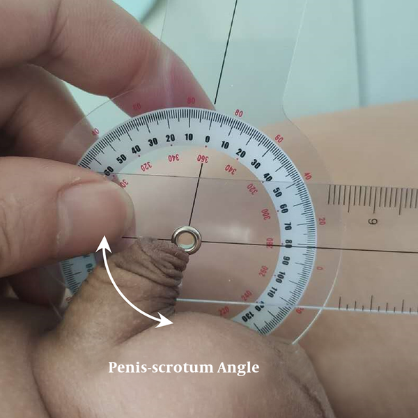 Representative image of measuring penis-scrotum angle using the protractor