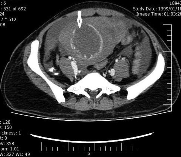 The axial contrast-enhanced CT scan shows a large, hypodense, heterogeneously ring-enhancing, expansile mass, distending the endometrial cavity, as well as necrosis with uterine rupture (arrow).