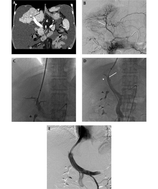 Hepatic artery guiding technique. A, Pre-procedural CT scan showing a large amount of ascites. The right hepatic artery (arrow head) traverses the inferior aspect of the main and right portal vein (arrow). B, Celiac angiography taken before transjugular intrahepatic portosystemic shunt (TIPS) procedure for hepatic artery guiding. Here, the right hepatic artery (arrow) was used as the reference. C, Right portal vein punctured with a 16-gauge Colapinto needle. To avoid hepatic artery injury, the puncture was attempted at the superior aspect of the wire. D, Portography obtained via a 5Fr catheter at the superior mesenteric vein. Here, puncture time was 9 min. The position of the wire (arrow head) in the hepatic artery and the catheter (arrow) in the portal vein. E, Final portography showing successful TIPS without complications. The pressure gradient between the portal vein and the inferior vena cava was roughly 10 mmHg.