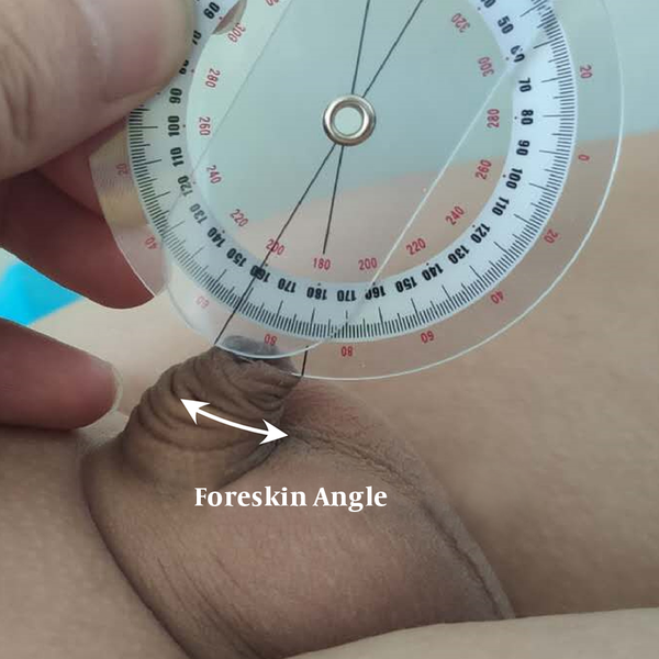 Representative image of measuring foreskin angle using the protractor