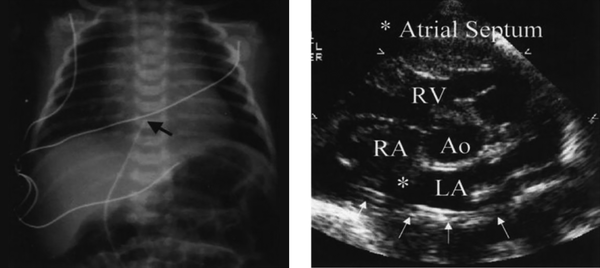 In 5-day-old baby, the tip of the umbilical catheter is located in the radiography in the right atrium and in the echocardiography simultaneously in the left atrium