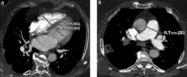 Axial CT images of a 53-year-old female patient presenting with shortness of breath. Right ventricle (RV) and left ventricle (LV) diameters were measured by identifying the widest distance between the ventricular endocardium and the interventricular septum. The ratio of RV to LV diameters was calculated (A). Pulmonary artery (PA) diameter was measured perpendicular to its long axis, from the inner wall to the inner wall, on an axial source image (B).