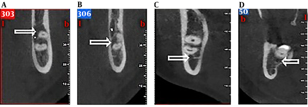 The relationship between JAR (arrows) and the mandibular canal in the JAR group: (A) superior, (B) inferior, (C) buccal, and (D) lingual and superior.
