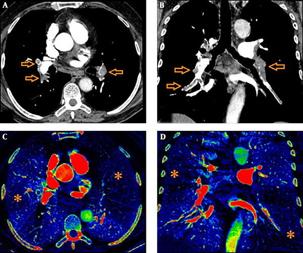 Axial (A) and coronal (B) CTA images of a 48-year-old male patient presenting with dyspnea. Filling defects suggesting thromboembolism are seen (arrows). There are perfusion defects on “rainbow” colour coded iodine perfusion maps in axial (C) and coronal (D) planes (stars).