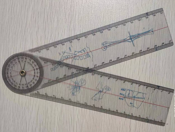 Multifunctional protractor for measuring foreskin angle and penis-scrotum angle