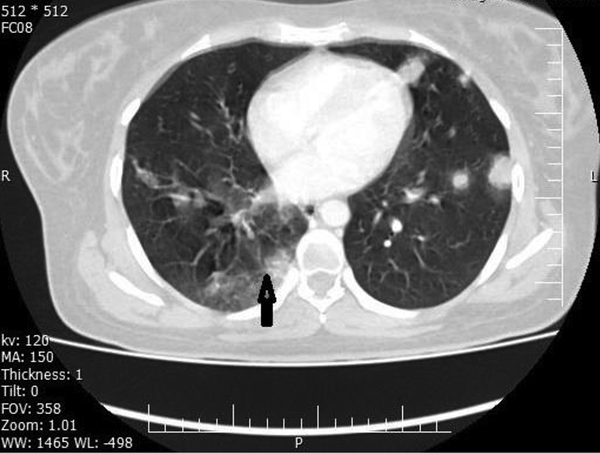 The axial CT scan shows multiple rounds to oval, well-defined, hypodens pulmonary nodules in the left lung due to metastasis, as well as ground-glass opacity in the apical segment of the right lower lobe (arrow), suggesting COVID-19 pneumonia.