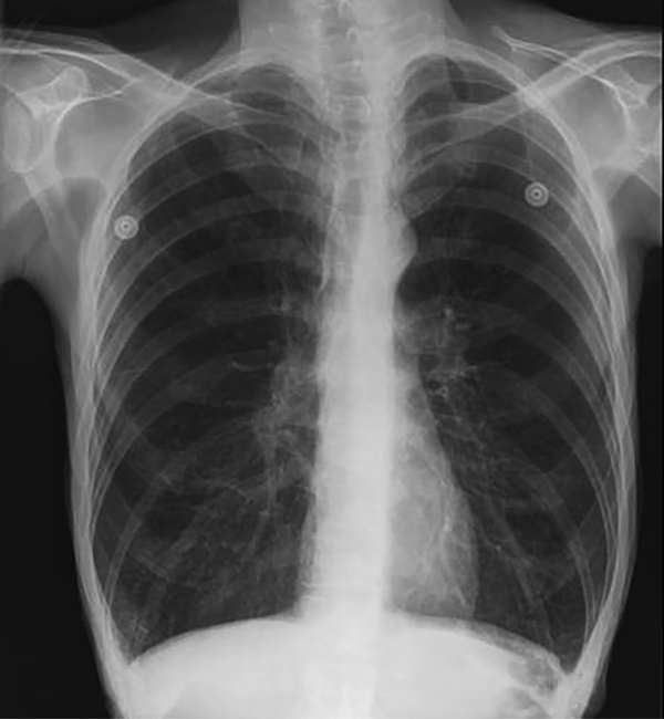 Chest X-ray illustrated diffuse bilateral patchy infiltration in case 2