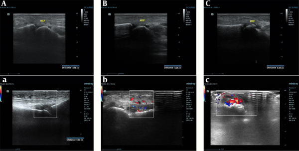 Ultrasonic evidence of RA patients in different activities. A, Gray-scale ultrasonic image of RA patients with low-activity. The image shows mild synovial fluid in MCP and GSUS is level 1. a, CDFI of RA patients with low-activity. No obvious blood flow signal is found, and PDUS is level 0. B, Gray-scale ultrasonic image of RA patients with moderate-activity. The image shows moderate synovial fluid in MCP and GSUS is level 2. b, CDFI RA patients with moderate-activity. Multiple dot-shaped blood flow signals are displayed, and CDUS is level 1. C, Gray-scale ultrasound image of RA patients with severe-activity. The image shows severe synovial fluid in MCP (0.33 cm) and GSUS is level 3. c, CDFI RA patients with severe-activity. Abundant blood flow signals are displayed, and CDUS is level 1. RA, rheumatoid arthritis; MCP, metacarpophalangeal; GSUS, gray-scale ultrasound; CDFI, color Doppler flow imaging; CDUS, Color Doppler ultrasound.