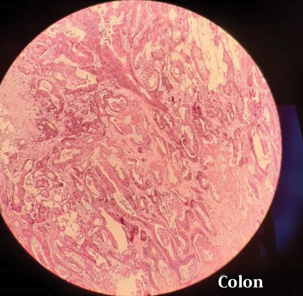 Colon mass pathology picture