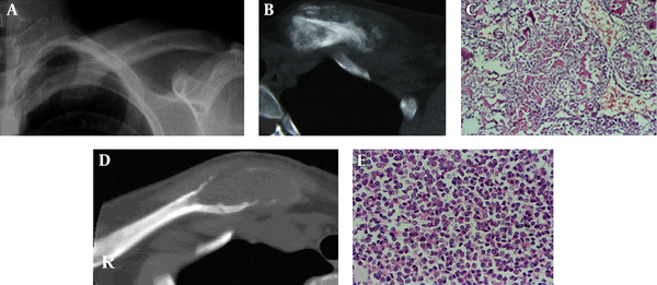 A-C, Osteosarcoma; D and E, Ewing’s sarcoma; A and B, An osteolytic destruction is demonstrated at the sternal end of the left clavicle with ill-defined margins, periosteal reaction, a lot of tumorous bone and soft tissue masses; C, Microscopically, the osteosarcoma is composed of tumor cells and tumor-like bone tissue which is produced directly by the tumor cells; D, An osteolytic, expansile destruction lesion is shown at the sternal end of the right clavicle with ill-defined margins, but no periosteal reaction and soft tissue masses; E, Microscopically, the Ewing’s sarcoma is composed of small round cells of the same size and shape, with few cytoplasm and fine nuclear chromatin.
