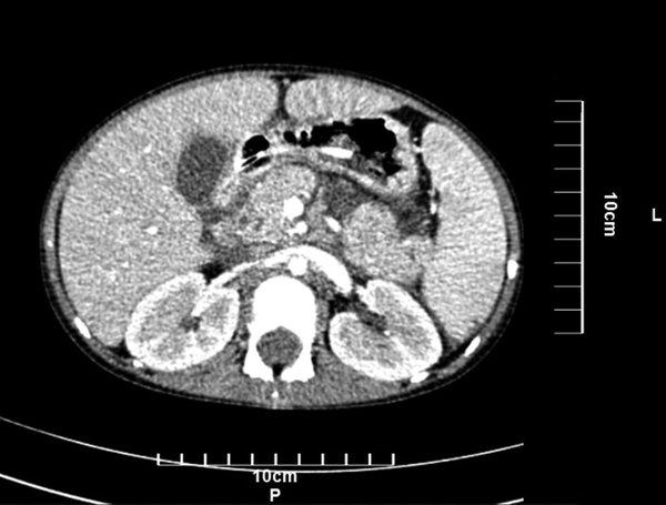 Splenomegaly with moderate free fluid in the abdominal cavity with enlarged pancreas head