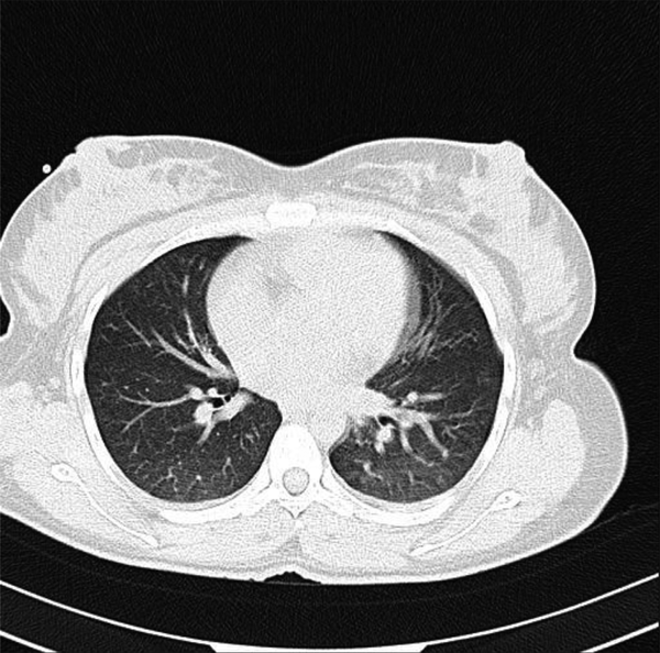 View of the mother’s chest CT scan
