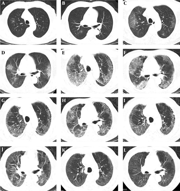 Chest CT images of a 69-year-old man with severe COVID-19 treated by hyperbaric oxygen. A and B, First CT on the day of disease onset shows a patchy ground-glass opacity (GGO) shadow in S I and S II segments of the upper lobe of the right lung; C and D, Five days after the onset, re-examination of CT shows large patches of GGO shadows in S I, S II and S III segments of the upper lobe of the right lung and S I + II segments of the upper lobe of the left lung; E and F, Sixteen days after the onset, re-examination of CT shows diffuse lesions in both lungs, extensive exudation and consolidation of the lung parenchyma, and the crazy-paving sign; G and H, Twenty-seven days after the onset and 8 days after the hyperbaric oxygen treatment, re-examination of CT shows that the range of consolidation in both lungs has decreased, the lung interlobular septum has thickened, and fibrous cord shadows appear in the lower right lung; I and J, Thirty-eight days after the onset and 19 days after the hyperbaric oxygen treatment, re-examination of CT shows that the consolidation density in both lungs has reduced, but the range has not changed; K and L, Sixty-five days after the onset, follow-up CT examination shows diffuse GGO shadows in both lungs and the consolidation shadows and fibrous cord shadows have completely resolved.