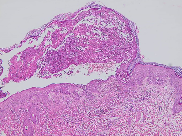 The histopathology evaluation of a skin lesion shows a suprabasal blister, acantolysis and inflammatory cell infiltrates (H&E, ×200, ×400)