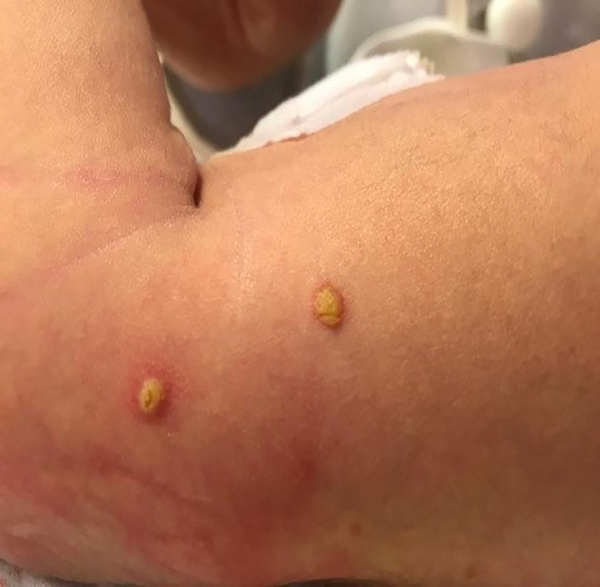 Pastular and bullous skin lesions on the arm of neonate