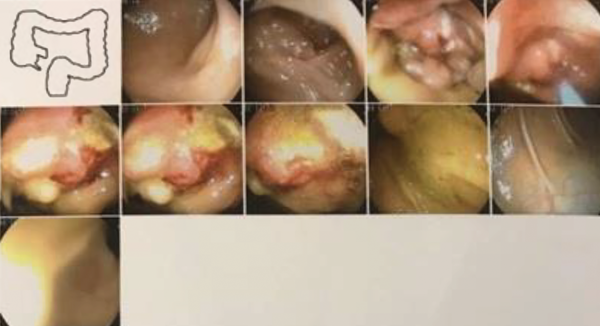 The patient colonoscopy that shows near to obstruction in the ascending colon because of hepatic flexure mass.