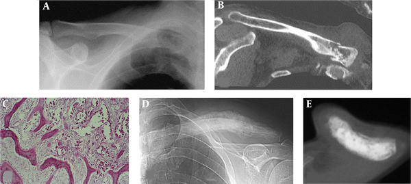 Metastatic tumors. A and B, At the sternal end of the right clavicle, osteolytic bone destruction is revealed with ill-defined margins, pathologic fracture and a soft tissue mass; C, Microscopy of the clavicle in (A) and (B) reveals metastatic adenocarcinoma of the lung with cancer cells forming an adenoid structure surrounded by reactive new bone; D and E, At the middle segment of the left clavicle, osteosclerotic bone destruction is shown with ill-defined margins, apparent periosteal reaction but no soft tissue masses.