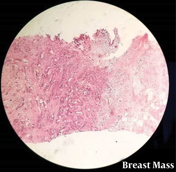 Breast mass pathology picture.