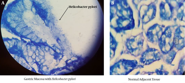 Histopathological features of gastric mucosa. A, Gastric mucosa with Helicobacter pylori; B, gastric mucosa of normal adjacent part