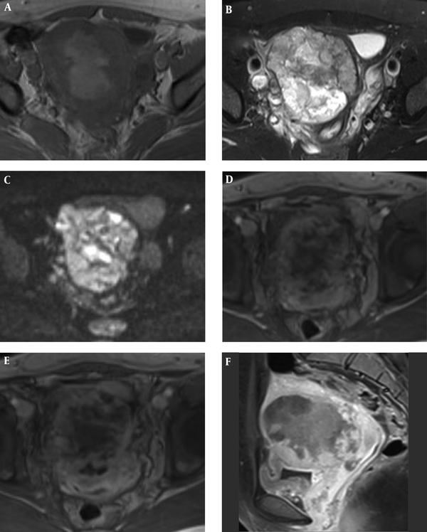 A 40-year-old woman with lower abdominal pain and dysmenorrhea who showed a lesion in the right side of the uterus in MRI. A, Axial T1WI imaging indicates that the lesion is iso- and slightly high-signal; B, Axial T2WI imaging indicates that the lesion is iso-, slightly low- and slightly high-signal; C, Axial DWI imaging indicates that the lesion shows diffusion restriction; D, Axial CE T1W MR imaging indicates that the lesion is uneven and shows mild enhancement in the early phase; E, Axial CE T1W MR imaging indicates that the lesion continues to strengthen in the venous phase; F, Delayed (3 minutes) contrast-enhanced sagittal T1WI shows the solid component of tumor enhanced close to the myometrium, multiple irregular unreinforced areas visible in the mass.