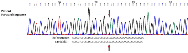Sequencing result of the NPHS2 exon 1 of the affected son in comparison to the reference sequence.