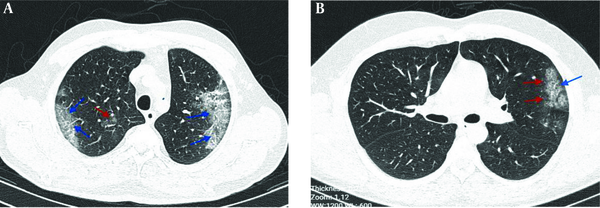 Chest CT images; A, an axial CT scan image without contrast in a 53-year-old male patient with cough, fever, and dyspnea, showing bilateral ground-glass opacities in the peripheral zones of LUL and RUL with pleural sparing distribution (blue arrows) and small round-shape ground-glass opacities with peribronchovascular distribution in RUL (red arrow); B, an axial CT scan image without contrast in a 29-year-old male patient with fever and dyspnea showing ground-glass opacities in the peripheral zone of LUL (red arrows) with pleural sparing distribution (arrow).