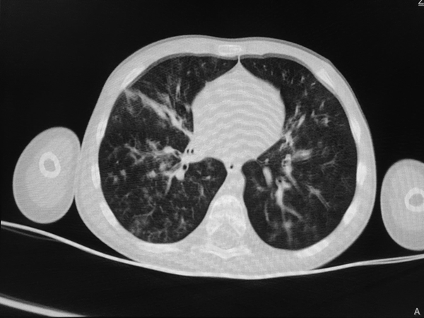 Bilateral peripheral ground glass opacity in the chest CT scan of a 4-year-old boy.
