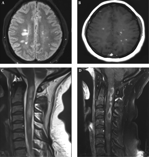Magnetic resonance imaging (MRI) of the brain and cervical cord