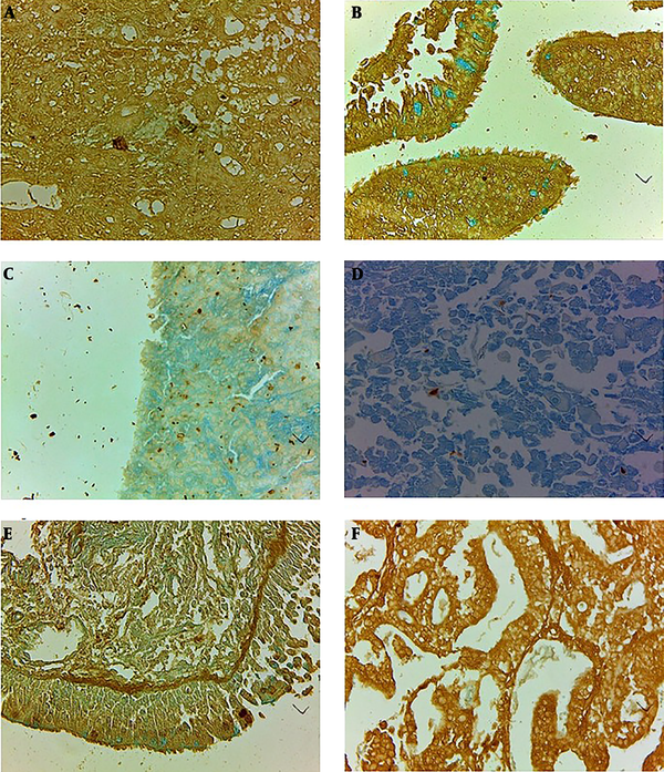 The moderate reaction of tumor stroma and cells of small cell lung carcinoma (a) in comparison to inflammatory mucosa and goblet cells (b) stained to lectin from Soya bean agglutinin (SBA/Alcian Blue), mild reaction of large cell lung carcinoma (c) to lectin from Ulex Europaeus agglutinin and no any reaction of squamous cell carcinoma (d) to lectin was shown. The reaction of inflammatory mucosa to UEA lectin for Fucose containing glycoconjugates restricted to supranuclear regions of columnar cells and also to elastic lamina beneath the epithelium of inflammatory mucosa (e) and moderate to severe staining of adenocarcinoma cells (f) to UEA lectin was clearly shown (magnification: 40×; Scale bar = 250 μm.).