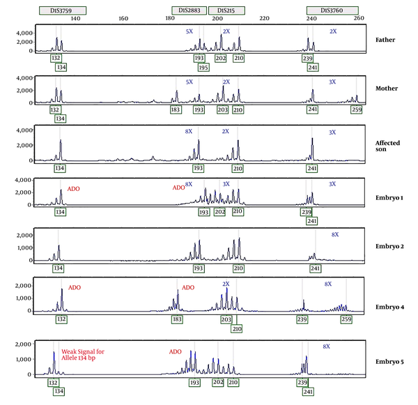 Electropherogram of the STRs linked to NPHS2 gene in PGD test. (ADO: allele drop out)