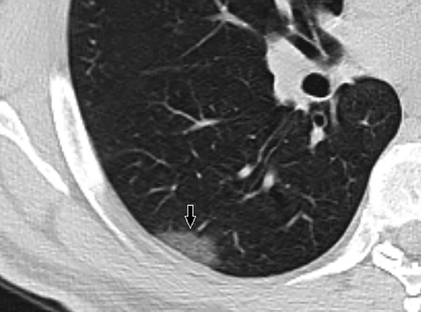 A 39-year-old man with dry cough and fatigue. The black arrow on the axial CT of the right lung shows ground-glass opacity with the peripheral distribution.