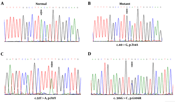 Electropherograms of the analyzed TSH-β sequences. A,  Normal allele in a Control case; B, homozygosity for the mutant allele (c.40A>G) in 3 pediatric patients; C, heterozygosity for the other mutant allele (c.32T>A) in one patient; and D, heterozygosity for the third mutant allele (c.316G>C) in one patient.