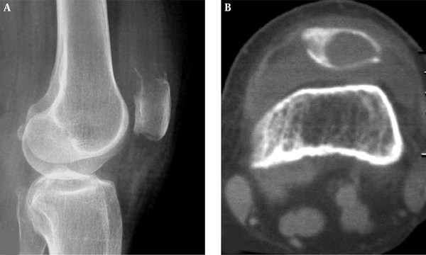 A patellar metastatic adenocarcinoma is shown. A lytic destruction area is demonstrated in the upper extremity of the patella with ill-defined margins and swelling joint capsule in plain radiography (A) and computed tomography (B). The trochlear groove is flat.